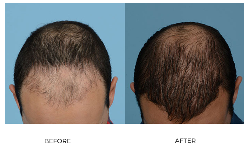 Hair Transplant Temecula, CA | Hair Restoration Temecula